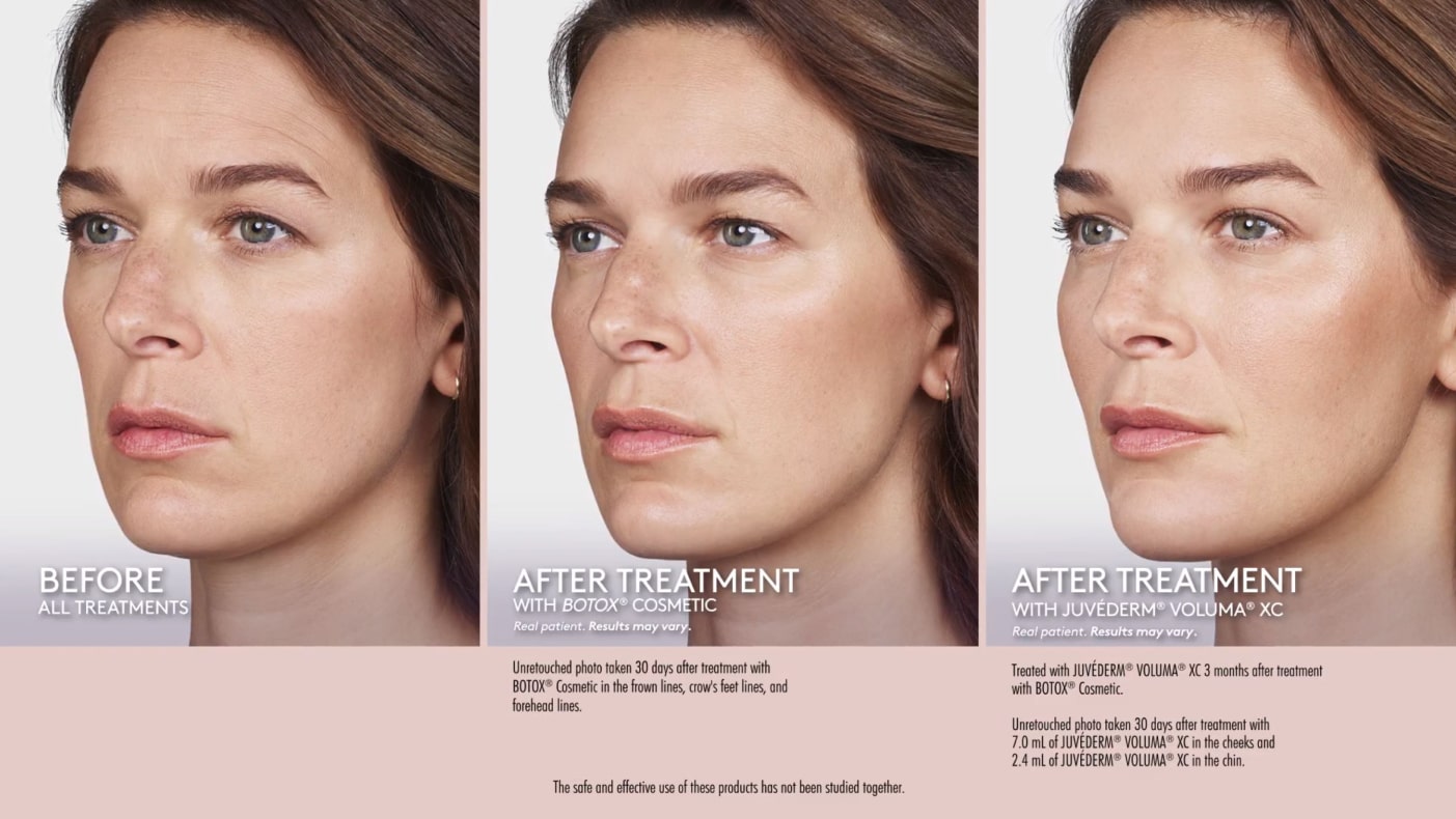 before and after juvederm and botox treatments
